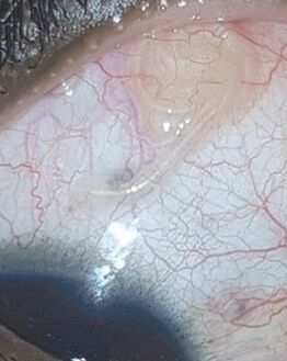 NEOflorax helped me get rid of a worm in my eye