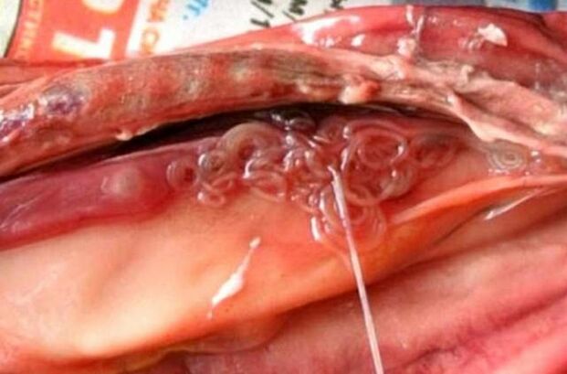 flu in the gall bladder
